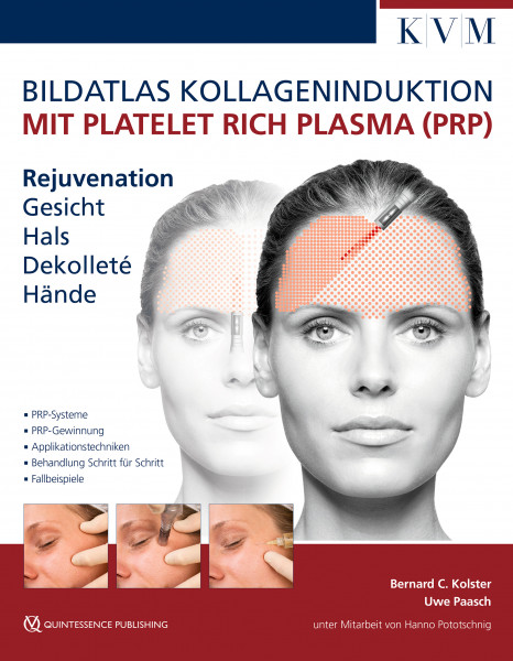 Bildatlas Kollageninduktion mit Platelet Rich Plasma (PRP) Rejuvenation Gesicht, Hals, Dekolleté